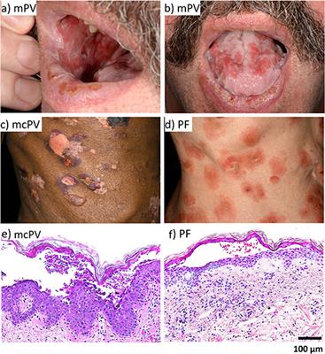 Autoantibody-Specific Signalling in Pemphigus